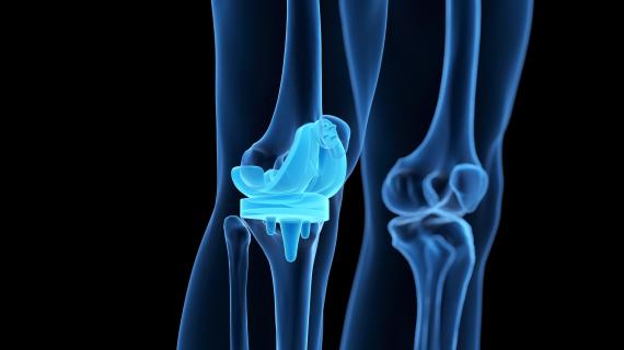 An x-ray of a knee, with a knee replacement implant highlighted.